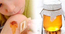Cách chữa lành vết thương nhanh chóng và hiệu quả bằng mật ong