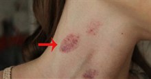 Hickey là gì?